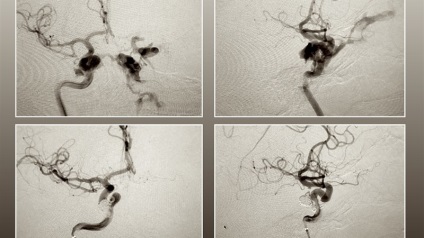 Anastomoza cavalenta carotida traumatica - cauze, simptome, tratament