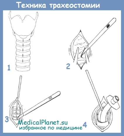 Traheotomie și tehnică pentru implementarea acesteia în stenoza laringelui și traheei