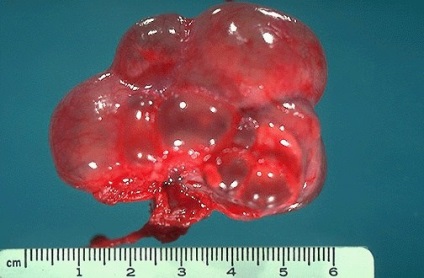 Oamenii de stiinta au descoperit noi metode de tratare a rinichilor polichistici 1
