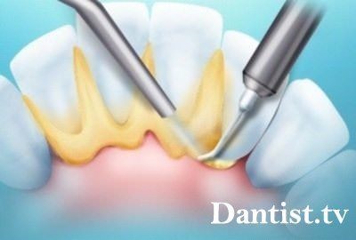 Îndepărtarea tartrului prin preț și fotografii cu laser