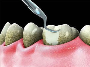 Eliminarea tartrului cu ultrasunete, laser, preț, recenzii, videoclipuri