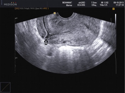 Posibilități de diagnostic ultrasunete și de gestionare a sarcinii în rumenul uterin - Cecenia