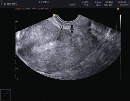 Posibilități de diagnostic ultrasunete și de gestionare a sarcinii în rumenul uterin - Cecenia