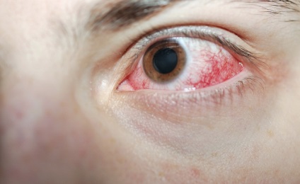 Cauze chimice ars ochi, simptome, tratament, vitaportal - sănătate și medicină