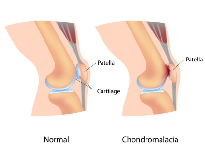 Tratamentul articulației genunchiului Chondromalacia
