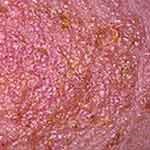 Eczemă cronică - cauze - tratament cu medicamente populare - eczemă uscată