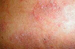 Eczeme infecțioase pentru alții sau nu
