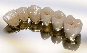 Coroane dentare pentru dinți de mestecat