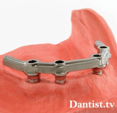 Dentures prețul acrilic detașabil, tipuri și fotografii