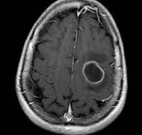 Abcesul creierului - cauze, simptome, diagnostic și tratament