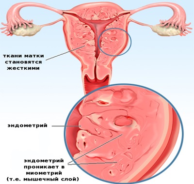 Adenomioza formei corpului uterin (difuz, focal), grade, cauze și simptome, tratament