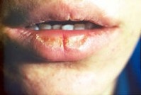 Avitaminoza, manifestare în cavitatea bucală