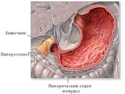 Durerea în stomac după masă și severitatea cauzei, medicamente și remedii folclorice, dieta