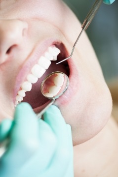Puncte negre pe dinți, ce este și cum să le tratezi