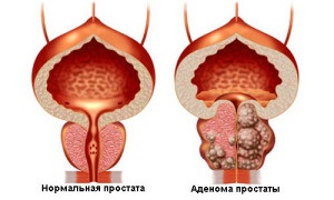 Ce este adenomul de prostată, care sunt simptomele și cum se tratează