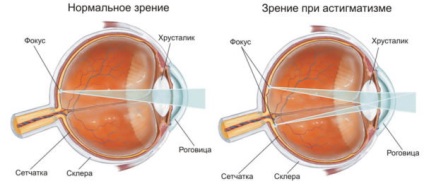 Ce este astigmatismul în cuvinte simple