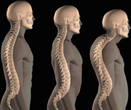 Ce este cifoza din clasificarea și tratamentul coloanei vertebrale