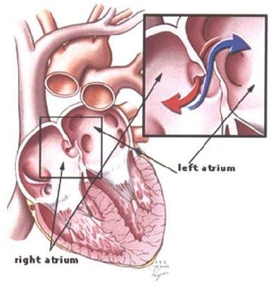 Septal defectul atrial