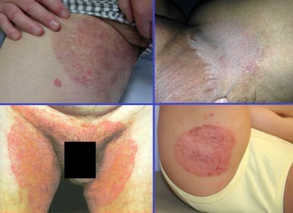 Dermatomicoza - simptome și tratament, fotografie