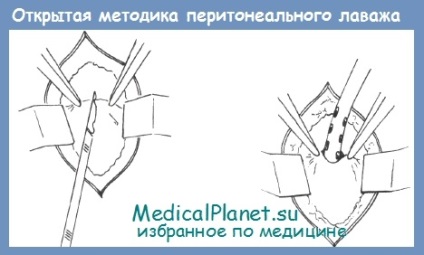 Diagnostic lavaj peritoneal