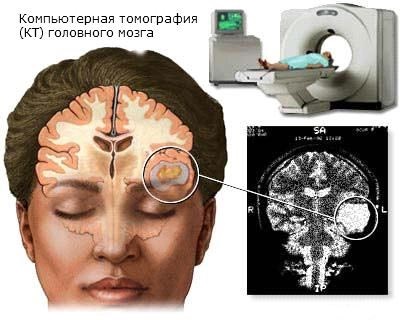 Diagnosticul tumorilor cerebrale