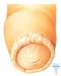 Genital Candidiasis