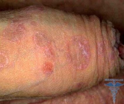 Genitális Candidiasis