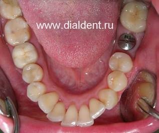 Implantarea dinților