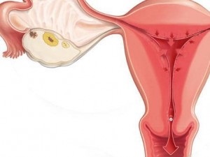 Modificarea lunară după apoplexia ovariană