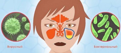 Cum să identificați simptomele sinuzitei și primele semne, tratamentul cronic și acut la domiciliu