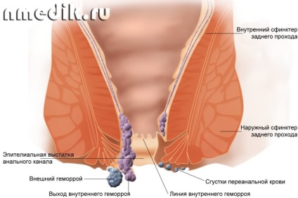 Cum sa tratezi corect hemoroizii