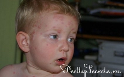 Cum să tratați în mod adecvat varicela la copii
