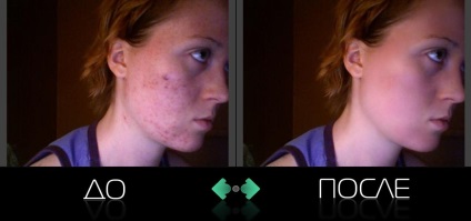 Cum să editați o retușare a fotografiilor în camera de lumină 4 pentru a elimina lightgrime-ul acneei