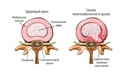 Cum sa alegi o saltea ortopedica cu o hernie a coloanei vertebrale