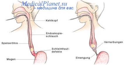 A nyelőcső külföldi testének klinikája