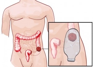 Colostomie, totul despre stoma