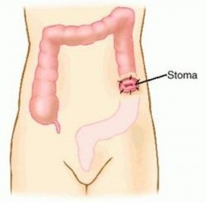 Colostomie, totul despre stoma