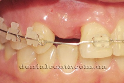 Ortodonție dentară combinată cu implantologie