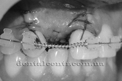 Kombinált fogászat ortodonzia implantológiával
