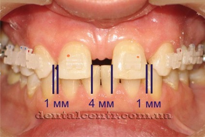 Kombinált fogászat ortodonzia implantológiával