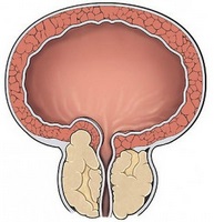 Komplex gyakorlatok kegel a krónikus prostatitis megelőzésére