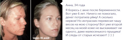 Крем за акне intraskin, отзиви за intraskin