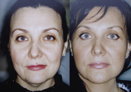 Circulară facelift este una dintre cele mai populare proceduri