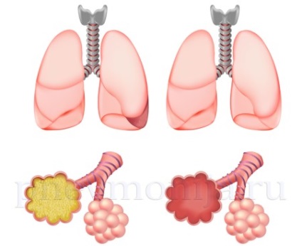 Croup pneumonia provoacă, simptome, etape, tratament