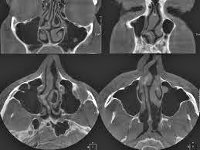 Ct of paranasal sinuses - árak Saint-Petersburg, talált 41 ár