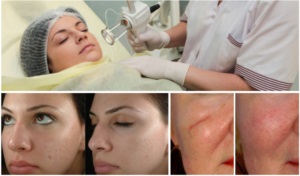 Refacerea pielii cu laser facial în medicină și cosmetologie