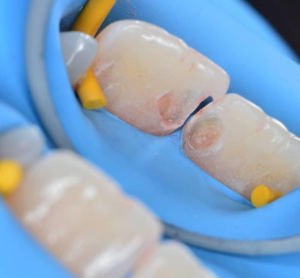 Novoszibirszkben a babafogak pulpitisének kezelése, a gyermekek állandó fogainak pulpitisének kezelése