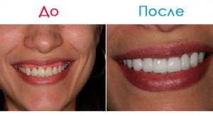 Lumineers pe dinți înainte și după fotografii, diferență cu furnir, argumente pro și contra