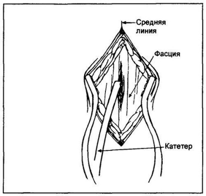 Manipularea în lavajul peritoneal de diagnosticare a abdomenului