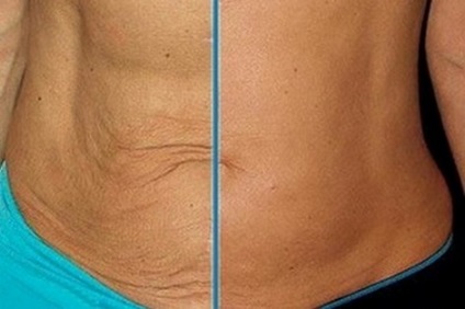 Mezoterapia abdomenului - fotografii înainte și după, recenzii ale femeilor privind procedura
